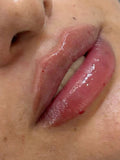 Hyaluron Lipp filler￼